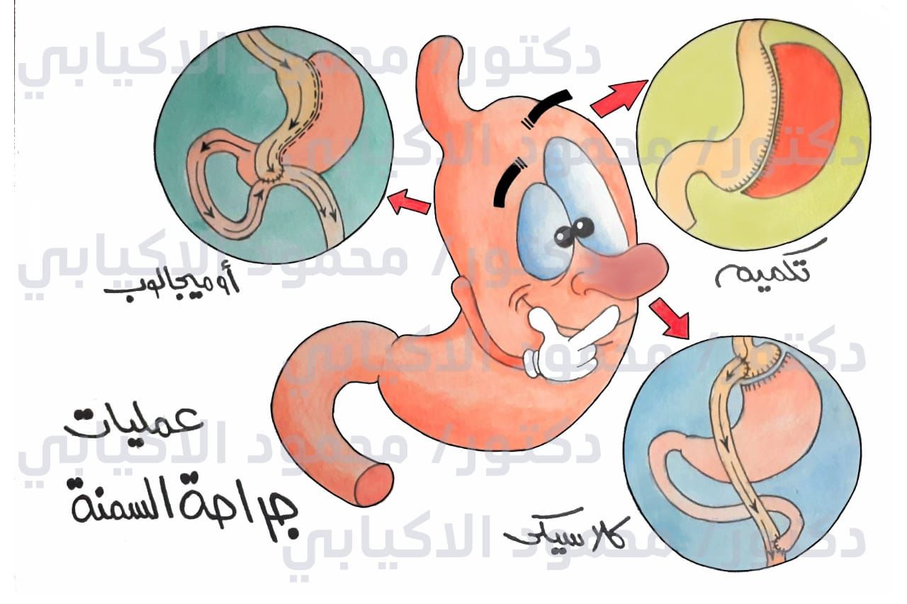 عملية الساسي (SASI)